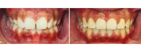 Impacted Teeth–Canines