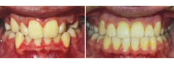 Anterior Crossbite