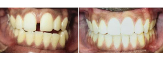 Orthognathic "Jaw" Surgery